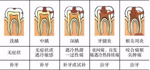 龋齿