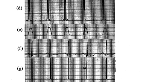 Pan-Tompkins心电QRS检测算法